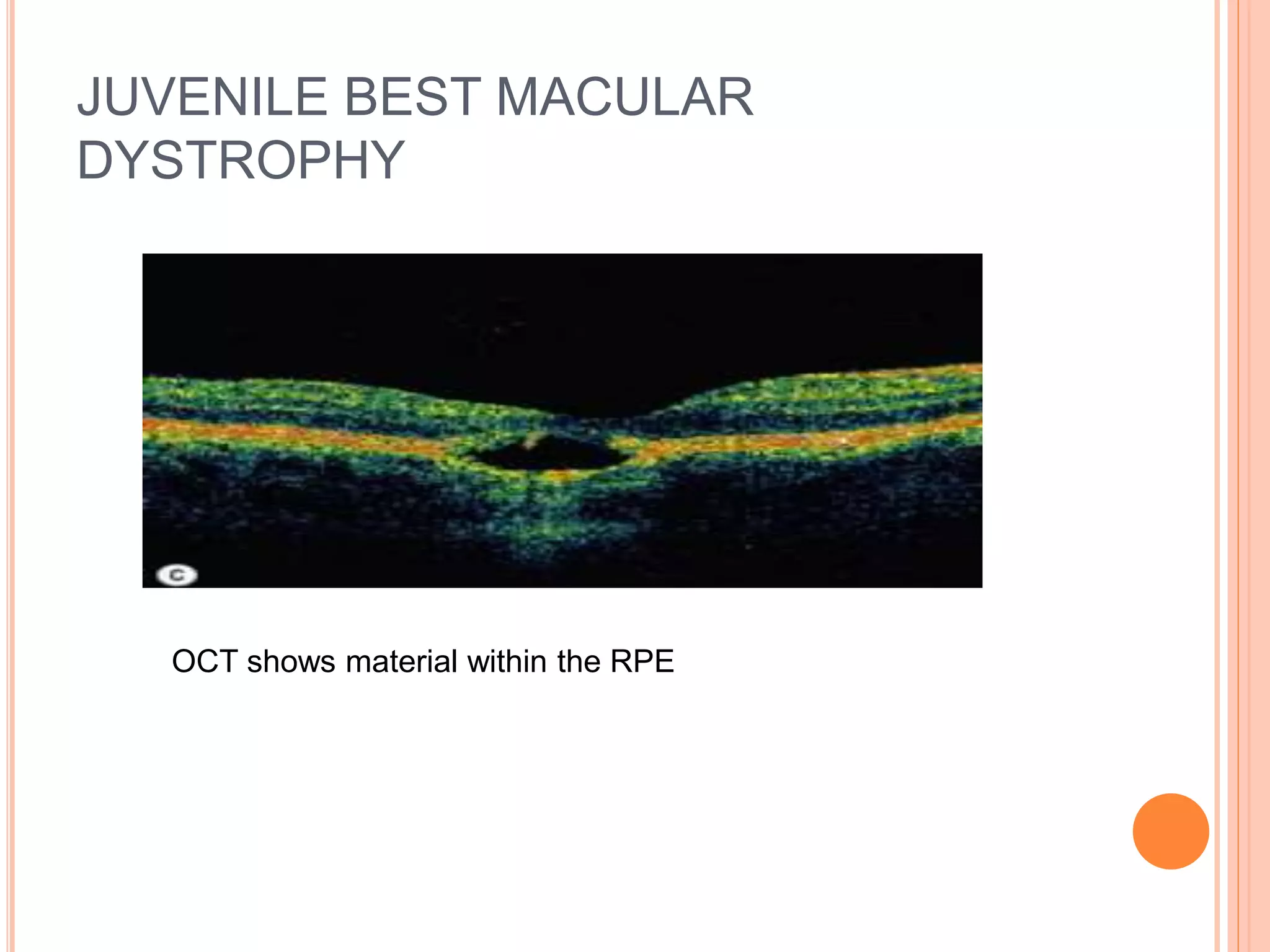 JUVENILE BEST MACULAR
DYSTROPHY
OCT shows material within the RPE
 