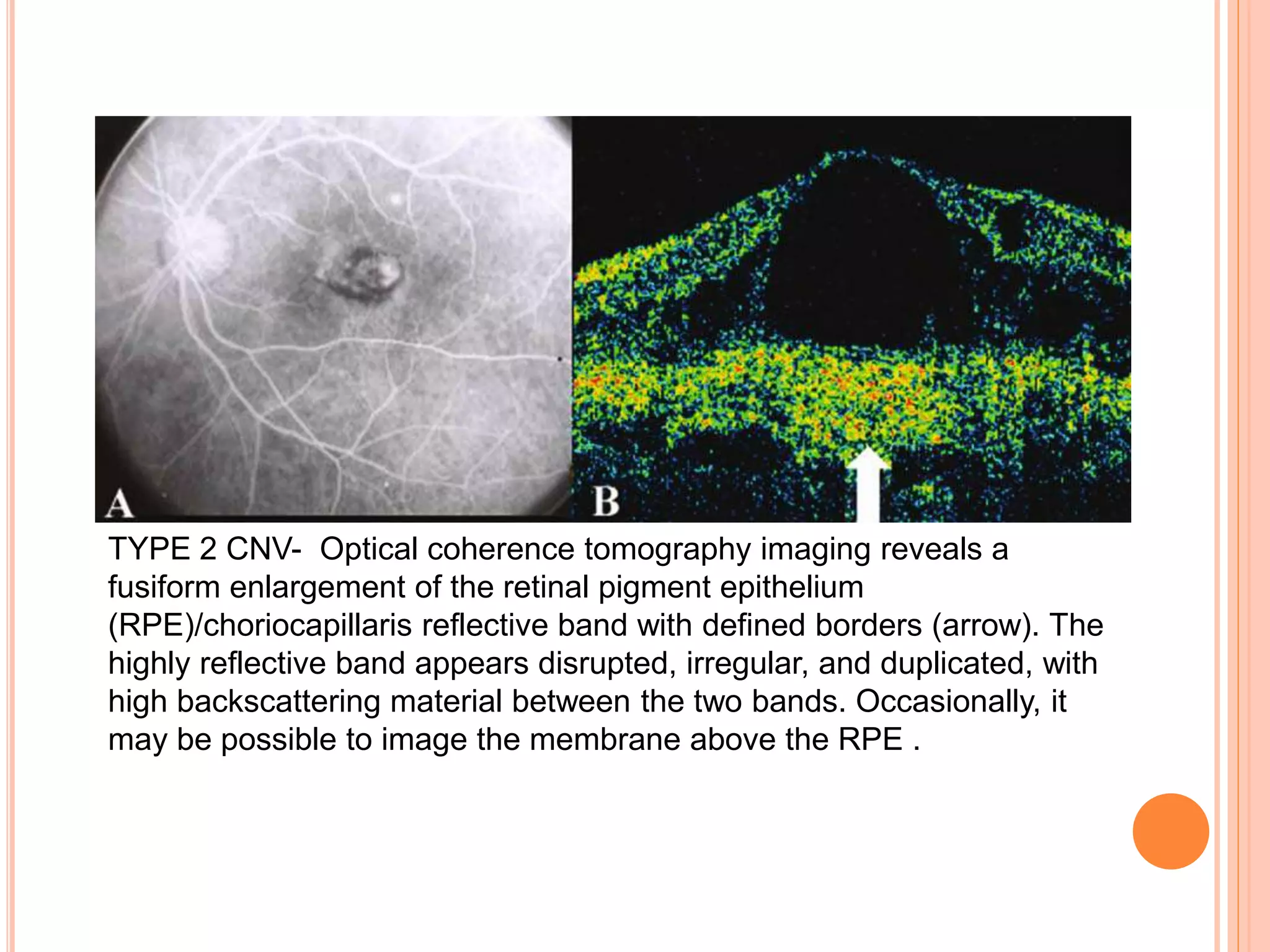 TYPE 2 CNV- Optical coherence tomography imaging reveals a
fusiform enlargement of the retinal pigment epithelium
(RPE)/choriocapillaris reflective band with defined borders (arrow). The
highly reflective band appears disrupted, irregular, and duplicated, with
high backscattering material between the two bands. Occasionally, it
may be possible to image the membrane above the RPE .
 