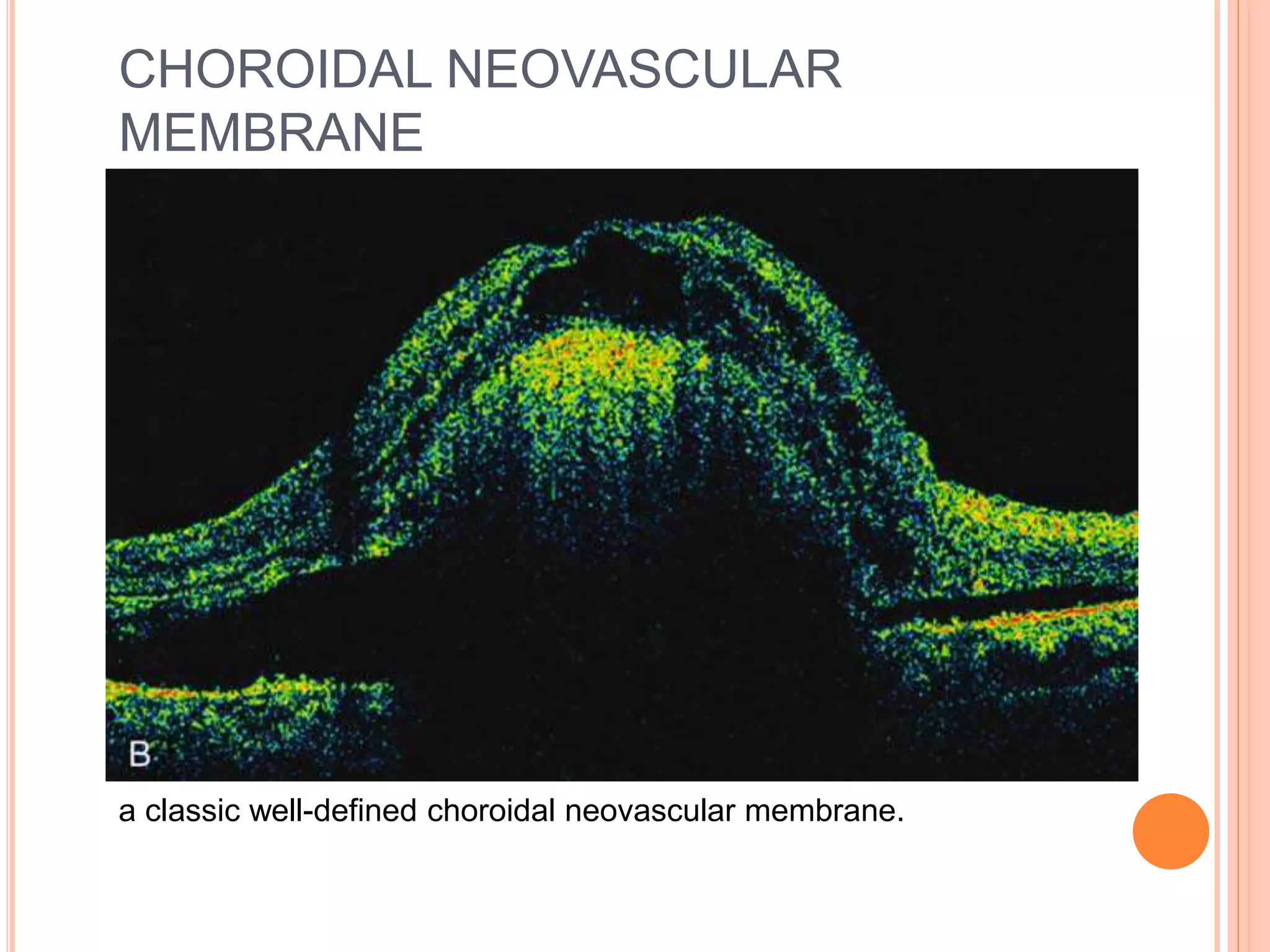 CHOROIDAL NEOVASCULAR
MEMBRANE
a classic well-defined choroidal neovascular membrane.
 