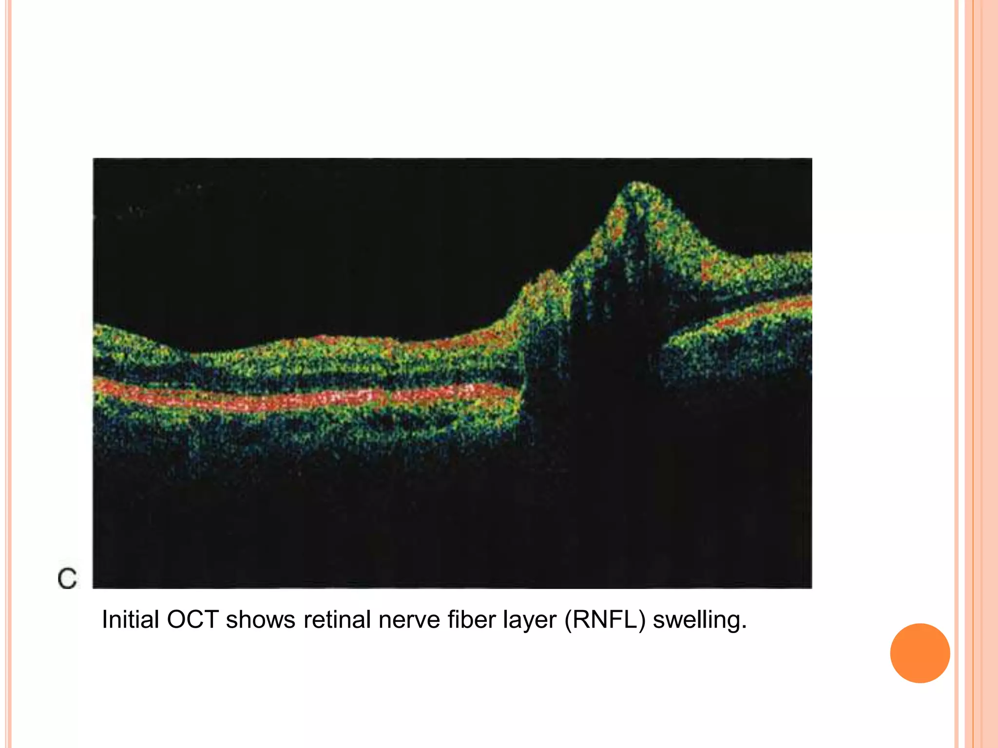 Initial OCT shows retinal nerve fiber layer (RNFL) swelling.
 