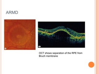 Optical Coherence Tomography(OCT) in posterior segment diseases | PPT
