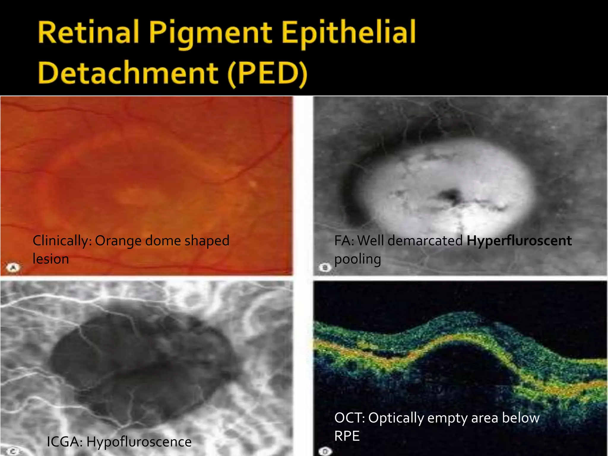 OCT – Introduction and Macular disorders | PPTX