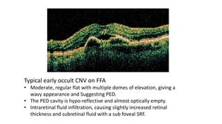 Typical early occult CNV on FFA
• Moderate, regular flat with multiple domes of elevation, giving a
wavy appearance and Suggesting PED.
• The PED cavity is hypo-reflective and almost optically empty.
• Intraretinal fluid infiltration, causing slightly increased retinal
thickness and subretinal fluid with a sub foveal SRF.
 