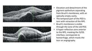 OCT IN WET AMD | PPT