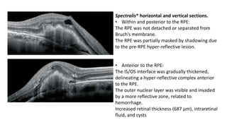 Spectralis* horizontal and vertical sections.
• Within and posterior to the RPE:
The RPE was not detached or separated from
Bruch’s membrane.
The RPE was partially masked by shadowing due
to the pre-RPE hyper-reflective lesion.
• Anterior to the RPE:
The IS/OS interface was gradually thickened,
delineating a hyper-reflective complex anterior
to the RPE.
The outer nuclear layer was visible and invaded
by a more reflective zone, related to
hemorrhage.
Increased retinal thickness (687 μm), intraretinal
fluid, and cysts
 