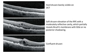 Hard drusen-barely visible on
OCT
Soft drusen-elevation of the RPE with a
moderately reflective cavity, which partially
reveals Bruch’s membrane with little or no
posterior shadowing.
Confluent drusen
 