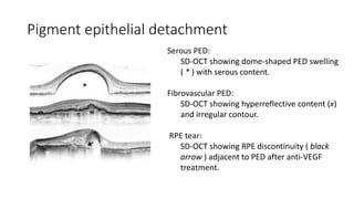 Pigment epithelial detachment
Serous PED:
SD-OCT showing dome-shaped PED swelling
( * ) with serous content.
Fibrovascular PED:
SD-OCT showing hyperreflective content (x)
and irregular contour.
RPE tear:
SD-OCT showing RPE discontinuity ( black
arrow ) adjacent to PED after anti-VEGF
treatment.
 