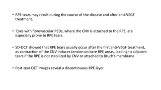• RPE tears may result during the course of the disease and after anti-VEGF
treatment.
• Eyes with fibrovascular PEDs, where the CNV is attached to the RPE, are
especially prone to RPE tears.
• SD-OCT showed that RPE tears usually occur after the first anti-VEGF treatment,
as contraction of the CNV induces tension on bare RPE areas, leading to adjacent
tears if the RPE is not stabilized by CNV or attached to Bruch’s membrane
• Post-tear OCT images reveal a discontinuous RPE layer
 