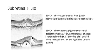 Subretinal Fluid
SD-OCT showing subretinal fluid ( x ) in
neovascular age-related macular degeneration.
SD-OCT shows serous pigment epithelial
detachment (PED, * ) with triangular-shaped
subretinal fluid (SRF, ° ) on the left side and
cystic changes (IRC) on the right side ( black
arrow )
 