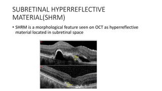 SUBRETINAL HYPERREFLECTIVE
MATERIAL(SHRM)
• SHRM is a morphological feature seen on OCT as hyperreflective
material located in subretinal space
 