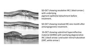 SD-OCT showing exudative IRC ( black arrow )
with underlying
pigment epithelial detachment before
treatment.
SD-OCT showing resolved IRC one month after
antiangiogenetic treatment.
SS-OCT showing subretinal hyperreflective
material (SHRM) with overlying degenerative
IRC ( black arrow ) and outer retinal tubulation
(ORT, white arrow )
 