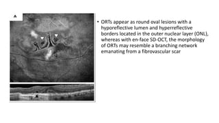 • ORTs appear as round oval lesions with a
hyporeflective lumen and hyperreflective
borders located in the outer nuclear layer (ONL),
whereas with en-face SD-OCT, the morphology
of ORTs may resemble a branching network
emanating from a fibrovascular scar
 