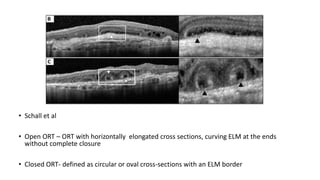 • Schall et al
• Open ORT – ORT with horizontally elongated cross sections, curving ELM at the ends
without complete closure
• Closed ORT- defined as circular or oval cross-sections with an ELM border
 