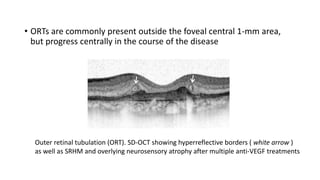 • ORTs are commonly present outside the foveal central 1-mm area,
but progress centrally in the course of the disease
Outer retinal tubulation (ORT). SD-OCT showing hyperreflective borders ( white arrow )
as well as SRHM and overlying neurosensory atrophy after multiple anti-VEGF treatments
 