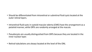 • Should be differentiated from intraretinal or subretinal fluid cysts located at the
outer retinal layers.
• Intraretinal fluid cysts in cystoid macular edema (CME) have the arrangement as a
petaloid manner, while ORTs are randomly arranged at the macula.
• Pseudocysts are usually distinguished from ORTs because they are located in the
inner nuclear layer.
• Retinal tubulations are always located at the level of the ONL
 