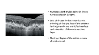 • Numerous soft drusen some of which
have resulted in atrophy.
• Loss of drusen in the atrophic area,
thinning of the rpe, loss of the external
limiting membrane and is/os interface
and alteration of the outer nuclear
layer.
• The inner layers of the retina remain
almost normal.
 