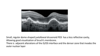 Small, regular dome-shaped juxtafoveal drusenoid PED has a less reflective cavity,
Allowing good visualization of bruch’s membrane.
There is adjacent alterations of the IS/OS interface and the denser zone that invades the
outer nuclear layer
 