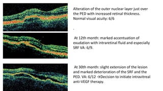 Alteration of the outer nuclear layer just over
the PED with increased retinal thickness.
Normal visual acuity: 6/6
.
At 12th month: marked accentuation of
exudation with intraretinal fluid and especially
SRF VA: 6/9.
At 30th month: slight extension of the lesion
and marked deterioration of the SRF and the
PED. VA: 6/12 →Decision to initiate intravitreal
anti-VEGF therapy.
 