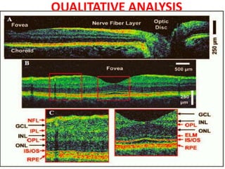 QUALITATIVE ANALYSIS
• Vitreous anterior to retina is non reflective :dark space.
• Vitreo retinal interface is well defined due to contrast
between the non reflective vitreous and backscattering
retina.
• Anterior boundary of retina :highly reflective RNFL 
red layer due to bright back scattering.
• Different intermediate layers of neurosensory retina
seen as an alternating layer of moderate and low
reflectivity
• Outer segment of retinal photoreceptors: minimally
reflective dark layer just anterior to RPE-
Choriocapillaries complex
• Posterior boundary of retina :red layer representing
highly reflective RPEand chorio capillaries.
 