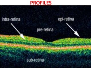 PROFILES
• For purposes of analysis, the OCT image of retina can
be subdivided vertically into four regions:
– pre-retina
– epi-retina
– intra-retina
– sub-retina
• OCT retinal morphology (form and structure) can be
subdivided into 4 with each profile with it's own set of
deformations and anomalous structures..
– pre-retinal profile.
– overall retinal profile.
– foveal profile.
– macular profile
 