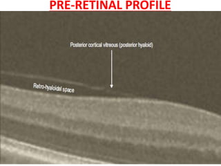 PRE-RETINAL PROFILE
• non reflective and is seen as a dark space.
• Viteroretinal interface is well defined due to
contrast between the non reflective vitreous and
the backscattering retina.
• Additional Vitreous Features
▶ Posterior cortical vitreous (posterior hyaloid)
▶ Retro-hyaloidal space
▶ noise :small, faint, bluish dots .
 