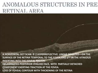 • HORIZONTAL OCT SCAN RE HYPERREFLECTIVE LINEAR STRUCTURE AT
THE RETINAL SURFACE ERM WITH MACULAR THICKENING.
• THE MEMBRANE IS ABSENT NASAL TO THE FOVEA.
• A HORIZONTAL OCT SCAN  2 HYPERREFLECTIVE LINEAR DENSITIES—ON THE
SURFACE OF THE RETINA TEMPORAL TO THE FOVEA AND 2ND IN THE VITREOUS
INSERTING INTO THE FOVEAL REGION.
• DELAMINATED POSTERIOR HYALOID FACE, WITH PARTIALLY DETACHED
COMPONENT EXERTING TRACTION AT THE FOVEA.
• LOSS OF FOVEAL CONTOUR WITH THICKENING OF THE RETINA
 