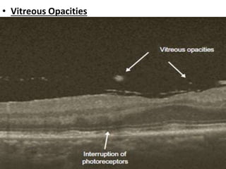• Vitreous Opacities
• Posterior vitreous opacities are seen as hyper-reflective
specks in the vitreous space
• The differential diagnosis includes:
▶ Vitritis
▶ Asteroid hyalosis
▶ Syneresis scintillans
▶ Operculum (e.g. related to a macular hole)
▶ Fungal hyphae.
 