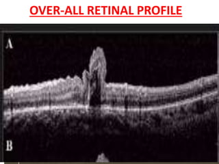OVER-ALL RETINAL PROFILE
• The normal over-all retinal profile has a slightly
concave curvature of surface of a globe.
• Abnormal profiles:
• exaggerated concavity and convexity.
• Retinal folds
 