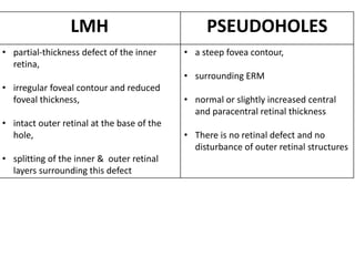 LMH PSEUDOHOLES
• partial-thickness defect of the inner
retina,
• irregular foveal contour and reduced
foveal thickness,
• intact outer retinal at the base of the
hole,
• splitting of the inner & outer retinal
layers surrounding this defect
• a steep fovea contour,
• surrounding ERM
• normal or slightly increased central
and paracentral retinal thickness
• There is no retinal defect and no
disturbance of outer retinal structures
 