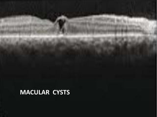 MACULAR HOLE
• A: Stage 1- Foveal pseudocyst;
• B: Stage 2- Full thickness macular hole (FTMH) with foveal vitreous
attachment;
• C: Stage FTMH with operculum and limited PVD (note papillary vitreous
attachment);
• D: Stage 4- FTMH with complete PVD
MACULAR CYSTS
 