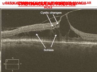 THE MACULAR PROFILE
• OCT scan length of 6 mm with 3 mm of the macula
on each side of the fovea.
• Deformations of macular profile
VITREOMACULAR ADHESION.EARLY VITREOMACULAR TRACTION/STAGE 1 MACULAR
HOLE
VITREOMACULAR TRACTION WITH MACULAR SCHISIS
 