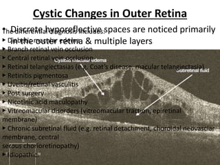 Cystic Changes in Outer Retina
• Discrete hyporeflective spaces are noticed primarily
in the outer retina & multiple layers
The differential diagnosis includes:
▶ Diabetic macular edema
▶ Branch retinal vein occlusion
▶ Central retinal vein occlusion
▶ Retinal telangiectasias (e.g. Coat’s disease, macular telangiectasia)
▶ Retinitis pigmentosa
▶ Uveitis/retinal vasculitis
▶ Post surgery
▶ Nicotinic acid maculopathy
▶ Vitreomacular disorders (vitreomacular traction, epiretinal
membrane)
▶ Chronic subretinal fluid (e.g. retinal detachment, choroidal neovasclar
membrane, central
serous chorioretinopathy)
▶ Idiopathic.
 