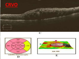 BRVO
• Retinal thickening and edema limited to the retinal area drained by the
obstructed vein.
CRVO
• A line scan through the macula : diffuse thickening with hyporeflective
spaces within the outer retinal layers CME.
• subretinal fluid due to excess intraretinal fluid ‘overflowing’ into the
subretinal space.
• macular edema over serial visits correlates well to visual acuity in non-
ischemic CRVO.
BRANCH RETINAL ARTERY OCCLUSION
• increased reflectivity and thickness of the inner retinal layers compatible
with the acute ischemic tissue insult.
CENTRAL RETINAL ARTERY OCCLUSION
• intense hyper-reflectivity of the inner retinal layers due to edema of the
retinal layers supplied by CRA.
• Shadowing effect:degrades the normal signal from the outer retinal layers,
therefore providing exaggerated contrast between them.
CRVO
 