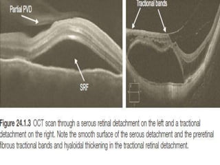 SUBRETINAL FLUID
• Clear hyporeflective space seen between the
neurosensory retina and RPE : clear SRF
• DD’S OF CLEAR SRF:
▶ Central serous chorioretinopathy
▶ Choroidal neovascular membranes (secondary to
e.g. age-related macular degeneration,
myopia)
▶ Serous retinal detachments (secondary to tumors,
inflammation, trauma)
▶ Rhegmatogenous retinal detachment
▶ Tractional retinal detachment
CSR
ABNORMAL NEOVASCULAR TISSUE PENETRATES THE RPE/BRUCH’S MEMBRANE
COMPLEX AND IS PRESENT IN THE SUBRETINAL SPACE
CLASSIC CNV:
ABNORMAL NEOVASCULAR TISSUE REMAINS UNDER THE RPE
:occult CNV
 