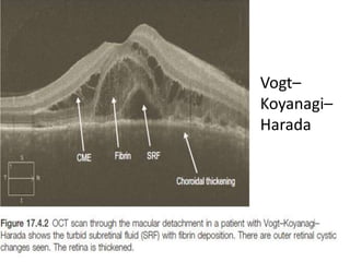 TURBID SUBRETINAL FLUID
• SRF may be turbid or have a higher reflectivity
than the vitreous in conditions where there is
fibrin deposition in the subretinal space.
• The differential diagnosis includes
▶ Chronic central serous chorioretinopathy
▶ Chronic choroidal neovascular membrane
▶ Sympathetic ophthalmia
▶ Vogt–Koyanagi–Harada syndrome
▶ Inflammatory serous retinal detachments
CSCR—C/c
Vogt–
Koyanagi–
Harada
 