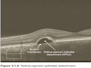 RETINAL PIGMENT EPITHELIAL
DETACHMENT
• This is noted as a dome-shaped separation of the RPE
from the underlying Bruch’s membrane.
• The space between the RPE and the Bruch’s membrane
is hyporeflective.
• The differential diagnosis includes:
▶ Age-related macular degeneration
▶ Central serous chorioretinopathy
▶ Choroidal neovascularization (e.g myopic degeneration,
presumed ocular histoplasmosis,angioid streaks)
▶ Idiopathic
 