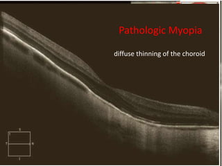 Atrophy of RPE
• causes decreased absorption of light. The OCT signal
penetrate more deeply, which exaggerates the typical
signal pattern : ‘reverse’ shadowing effect
• The differential diagnosis includes:
▶ Geographic atrophy
▶ Advanced chorioretinal scarring secondary to retinal
degenerations and macular dytrophies
(retinitis pigmentosa, Stargardt’s disease, cone dystrophy)
▶ Chorioretinal atrophy secondary to inflammatory
disorders (ocular histoplasmosis,multifocal choroiditis)
▶ Severe myopic degeneration
▶ Angioid streaks.
retinitis pigmentosa
Pathologic Myopia
diffuse thinning of the choroid
 