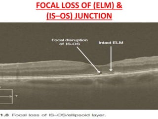 FOCAL LOSS OF (ELM) &
(IS–OS) JUNCTION
• severe outer retinal conditions such as cone
dystrophy, solar retinopathy
• inner retinal disorders when they advance to
involving the outer retinal layers.
 