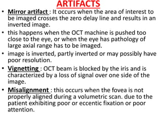 ARTIFACTS
• Mirror artifact : It occurs when the area of interest to
be imaged crosses the zero delay line and results in an
inverted image.
• this happens when the OCT machine is pushed too
close to the eye, or when the eye has pathology of
large axial range has to be imaged.
• image is inverted, partly inverted or may possibly have
poor resolution.
• Vignetting : OCT beam is blocked by the iris and is
characterized by a loss of signal over one side of the
image.
• Misalignment : this occurs when the fovea is not
properly aligned during a volumetric scan. due to the
patient exhibiting poor or eccentic fixation or poor
attention.
 