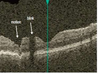 • Blink artifact : partial loss of data due to the
momentary blockage of OCT image acquisition
during the blink. recognized as black horizontal bars
across the OCT image.
• Motion artifact :occurs when there is movement of
the eye while scanning ->distortio.It is seen as a
sharp change in contour on the B-scan and as
misalignment of blood vessels.
 