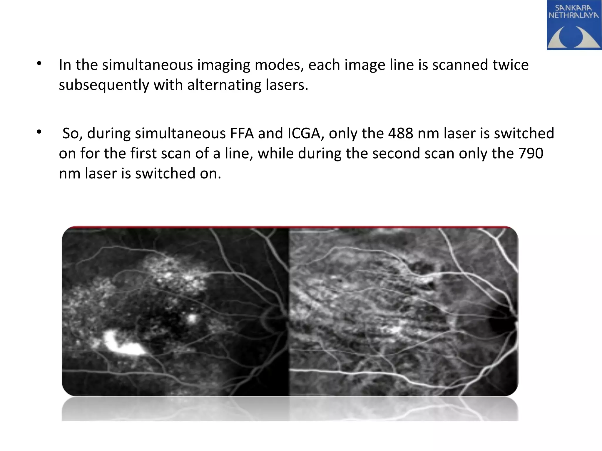 • In the simultaneous imaging modes, each image line is scanned twice
subsequently with alternating lasers.
• So, during simultaneous FFA and ICGA, only the 488 nm laser is switched
on for the first scan of a line, while during the second scan only the 790
nm laser is switched on.
 