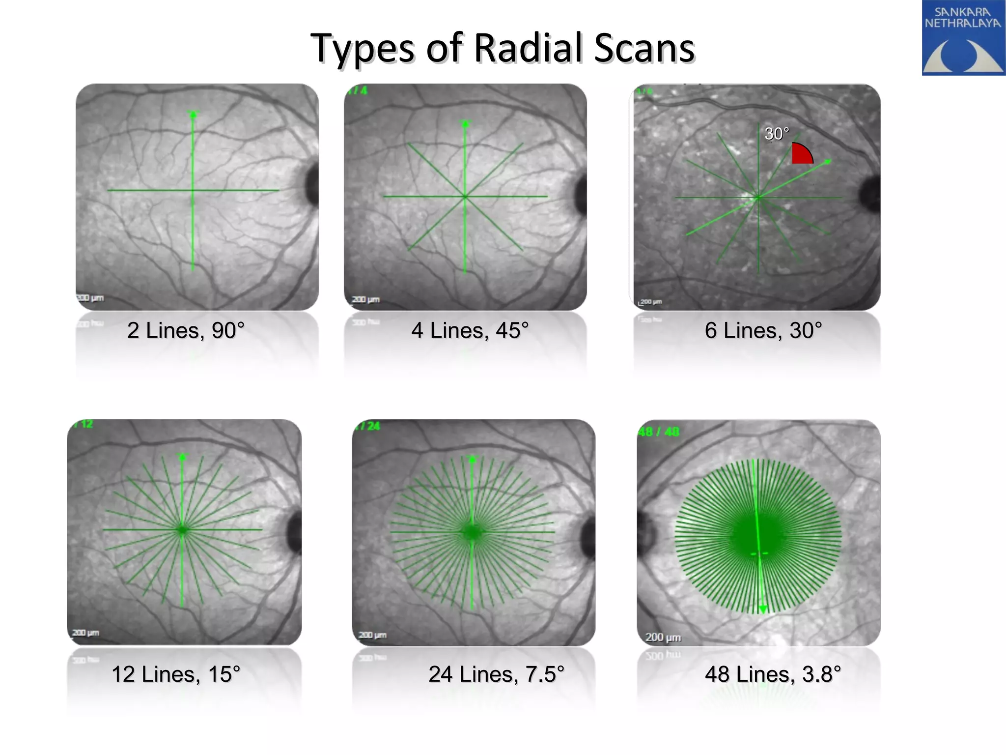 Types of Radial ScansTypes of Radial Scans
30°30°
4 Lines, 45°4 Lines, 45° 6 Lines, 30°6 Lines, 30°
12 Lines, 15°12 Lines, 15° 24 Lines, 7.5°24 Lines, 7.5° 48 Lines, 3.8°48 Lines, 3.8°
2 Lines, 90°2 Lines, 90°
 