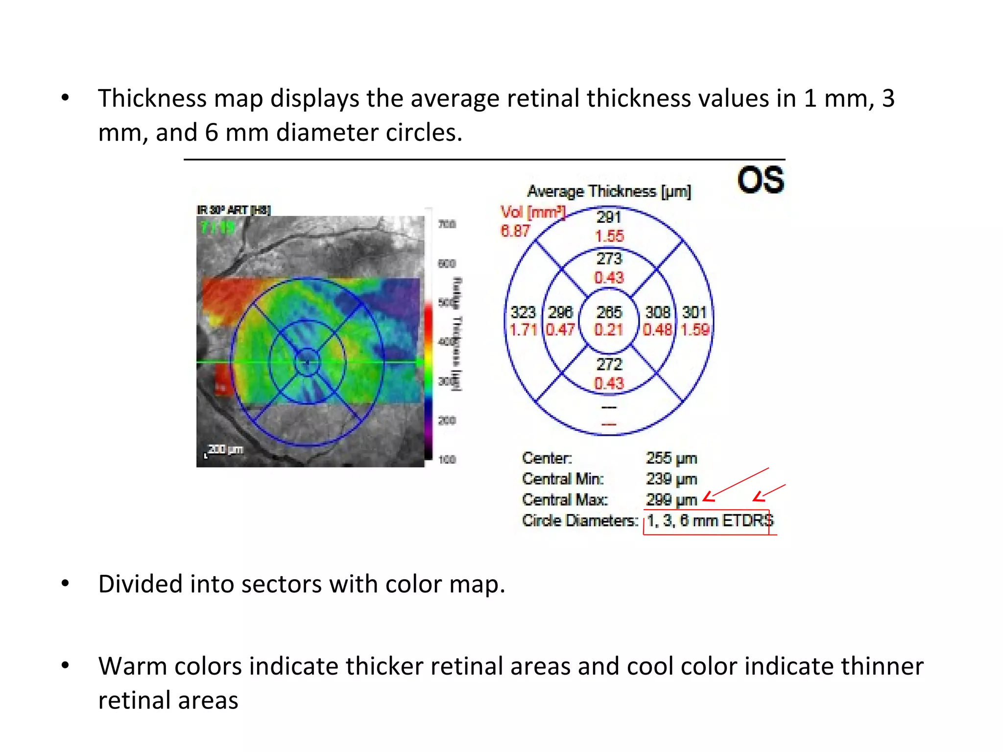 • Thickness map displays the average retinal thickness values in 1 mm, 3
mm, and 6 mm diameter circles.
• Divided into sectors with color map.
• Warm colors indicate thicker retinal areas and cool color indicate thinner
retinal areas
 