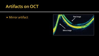 Oct Artefact Example Optical Coherance Tomography (OCT) in Vitreo Retina and Choroid | PPTX