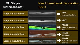 Vmt Classification OCT of Vitreomacular interface (VMI) | PPTX