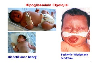 Hipogliseminin Etyolojisi




                               Beckwith- Wiedemann
Diabetik anne bebeği           Sendromu
                                                     18
 