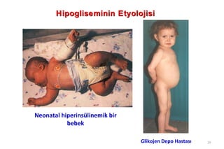 Hipogliseminin Etyolojisi




Neonatal hiperinsülinemik bir
           bebek

                                Glikojen Depo Hastası   20
 