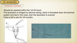 • Should be repaired within the 1st 24 hours
• The laceration is bridged by silicone tubing, which is threaded down the lacrimal
system and tied in the nose, then the laceration is sutured
• Tube is left in-situ for 3-6 months
Canalicular Laceration
 