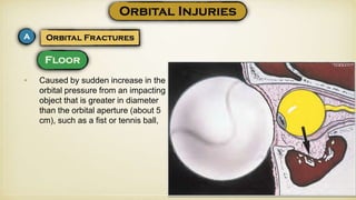• Caused by sudden increase in the
orbital pressure from an impacting
object that is greater in diameter
than the orbital aperture (about 5
cm), such as a fist or tennis ball,
 