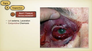 • Lid oedema, Laceration
• Conjunctiva Chemosis
 